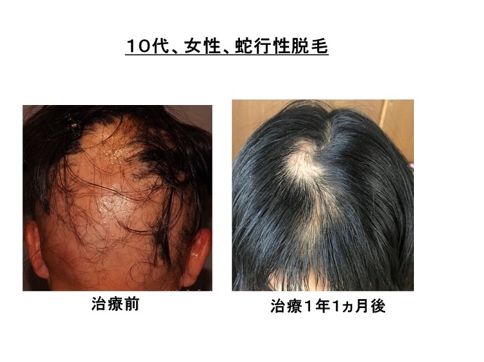円形脱毛症　病院